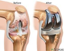 Extension of Knee-Implants ceiling prices